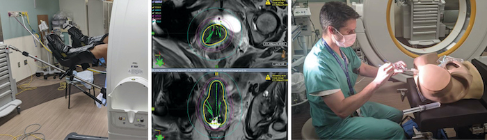 Brachytherapy montage