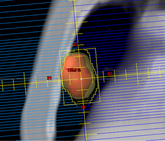 Dynamic Conformal Arc Novel Treatment Delivery 