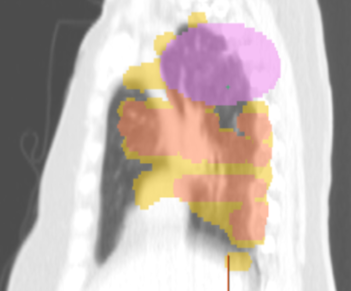 Stereotactic Body Radiation Therapy (SBRT), a widely used, non-invasive treatment for early-stage non-small cell lung cancer (NSCLC)