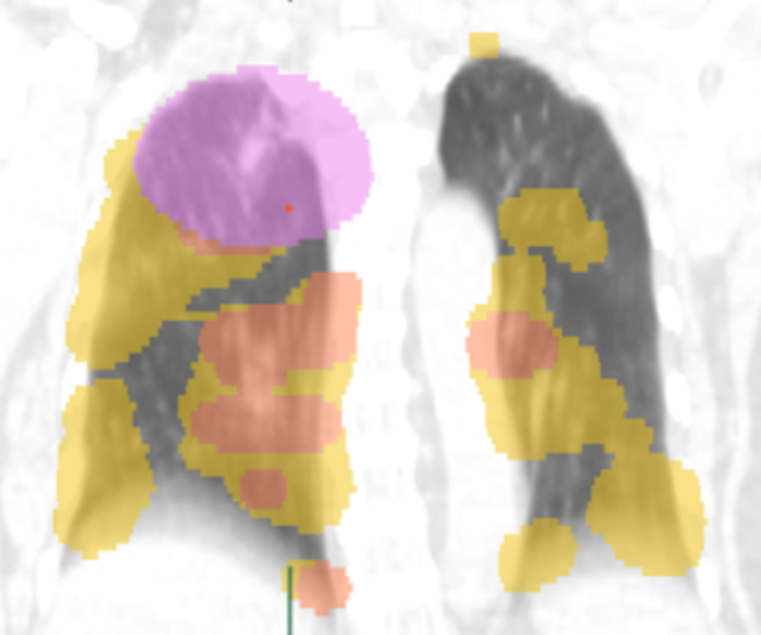 Stereotactic Body Radiation Therapy (SBRT), a widely used, non-invasive treatment for early-stage non-small cell lung cancer (NSCLC)